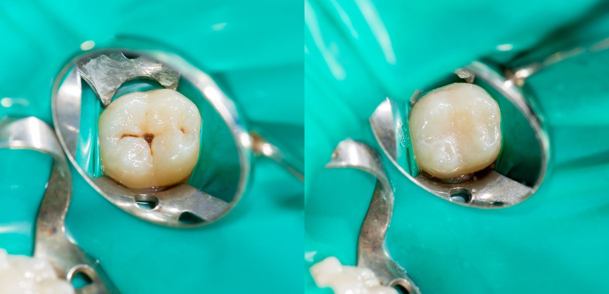 Factors Which Influence a Composite Filling's Longevity - Cary Implant and General Dentistry
