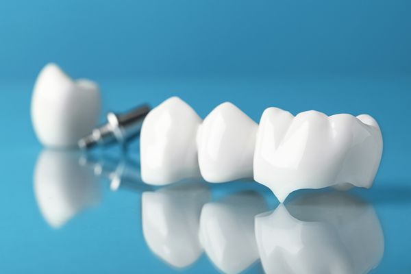 Dental Crowns and Bridges Cary, NC - Cary Implant and General Dentistry