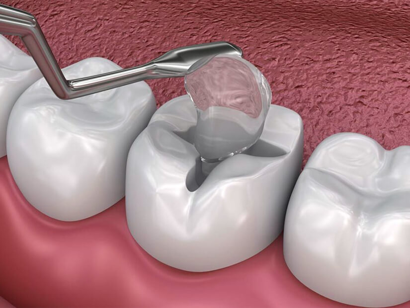 Dental Fillings Cary NC - Cary Implant and General Dentistry
