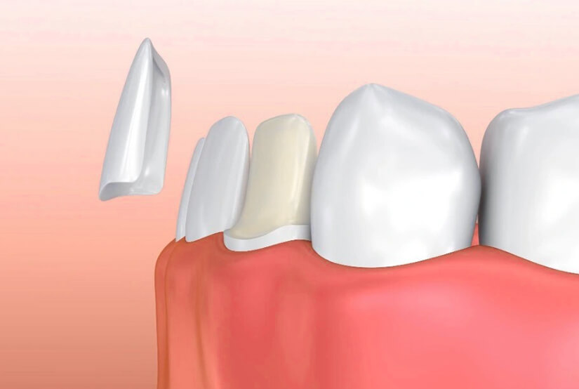 Porcelain Veneers Cary, NC - Cary Implant and General Dentistry