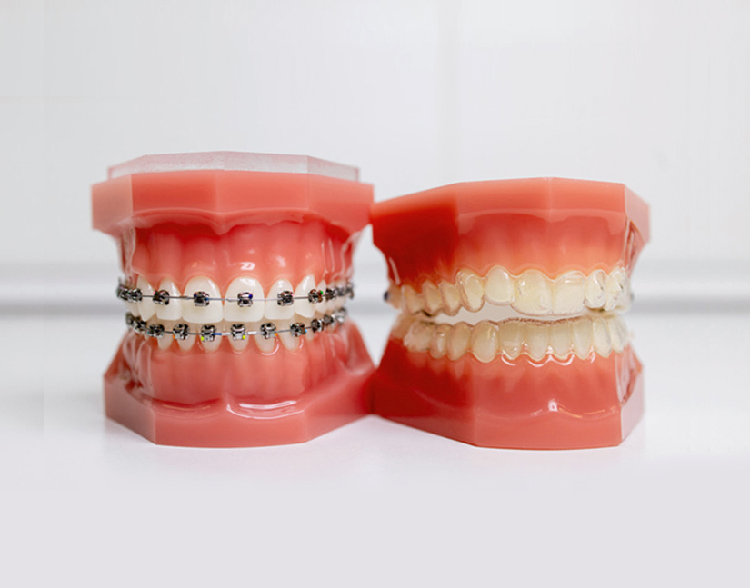 Orthodontics Cary NC - Cary Implant and General Dentistry