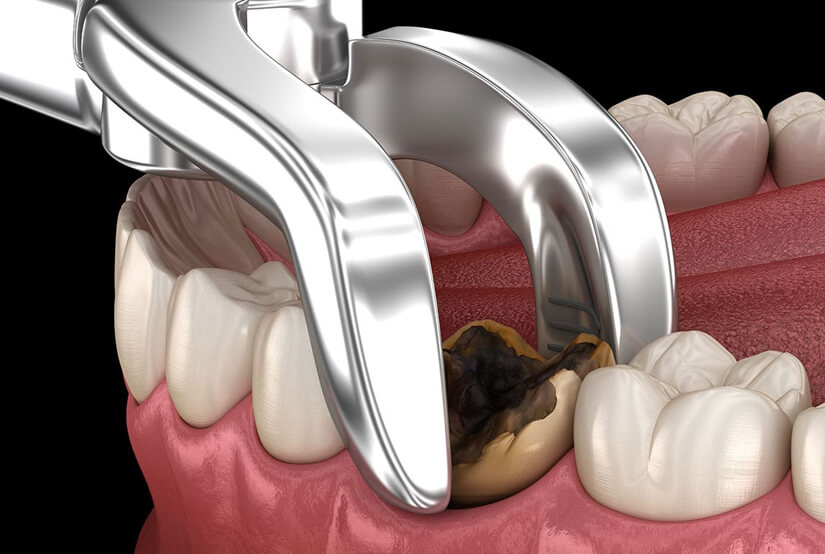 Tooth Extractions in Cary, NC - Cary Implant and General Dentistry