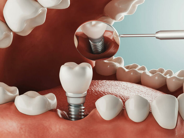 dental implant dental service