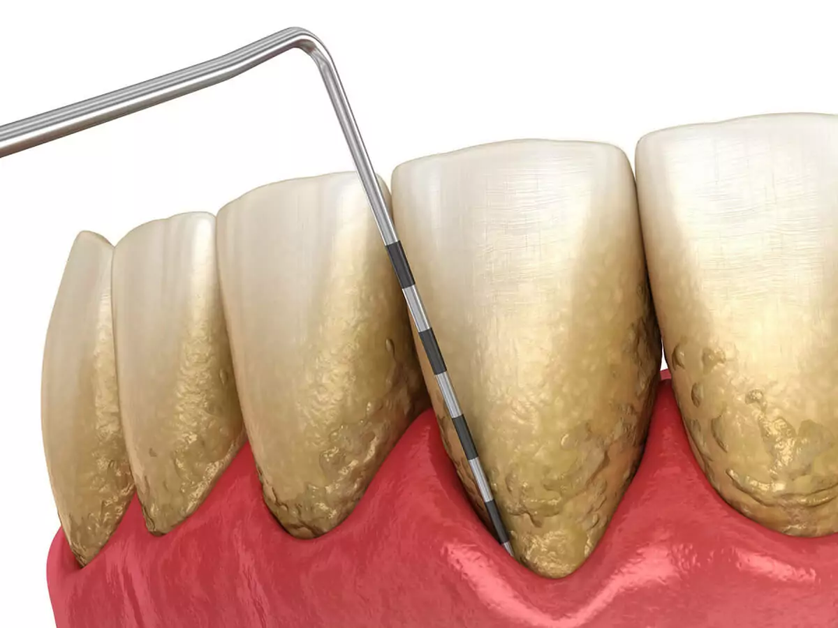 Gum Disease Treatment