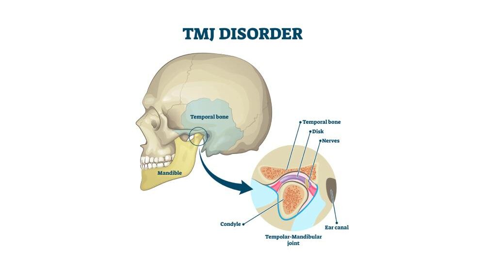 TMJ Disorder