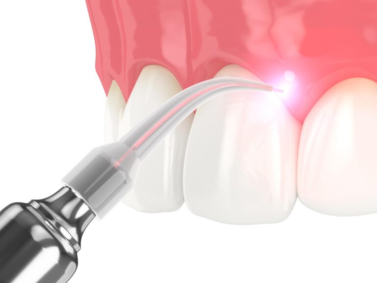 soft tissue laser