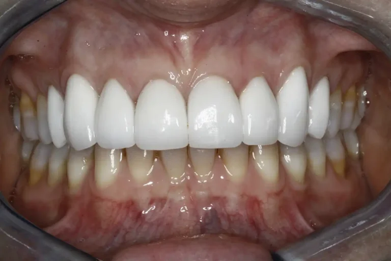 Teeth after dental veneers at Cary Implant and General Dentistry in Cary, NC.