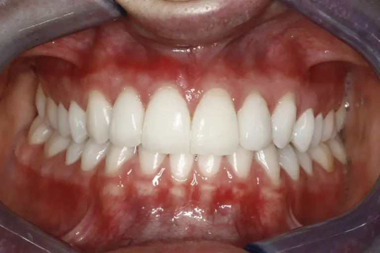 Teeth after dental veneers at Cary Implant and General Dentistry in Cary, NC.