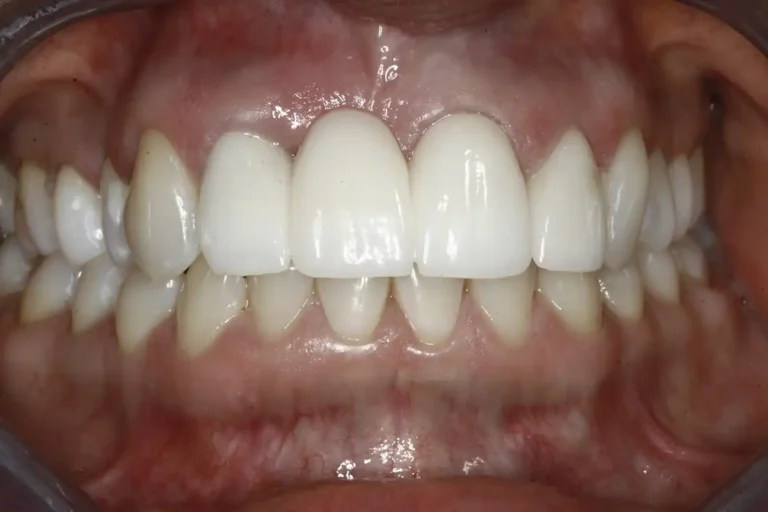 After anterior dental implants at Cary Implant and General Dentistry in Cary, NC.