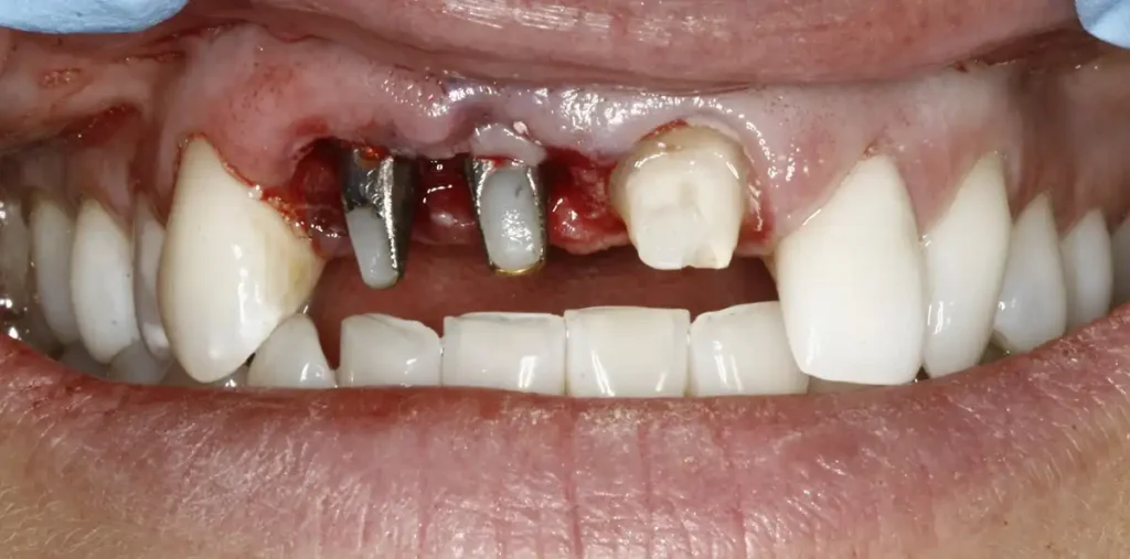 Before anterior dental implants at Cary Implant and General Dentistry in Cary, NC.