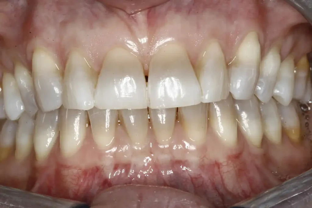 Teeth before dental veneers at Cary Implant and General Dentistry in Cary, NC.