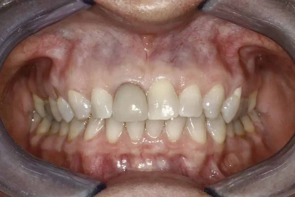 Teeth before dental veneers at Cary Implant and General Dentistry in Cary, NC.