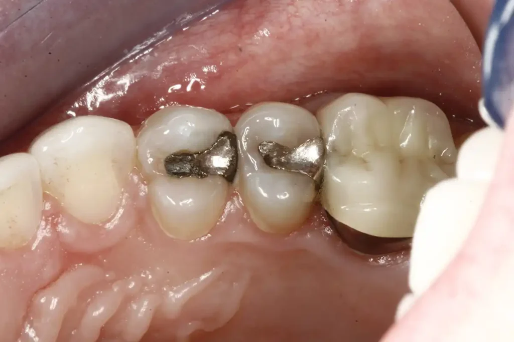 Teeth before a tooth colored dental filling using CEREC technology at Cary Implant and General Dentistry in Cary, NC.