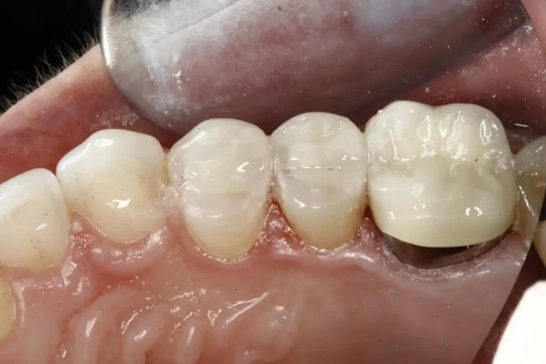 Teeth after a tooth colored dental filling using CEREC technology at Cary Implant and General Dentistry in Cary, NC.