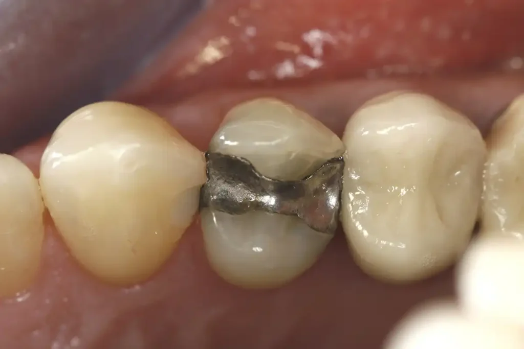 Teeth before a tooth colored dental filling using CEREC technology at Cary Implant and General Dentistry in Cary, NC.
