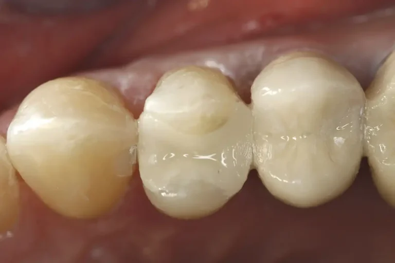 Teeth after a tooth colored dental filling using CEREC technology at Cary Implant and General Dentistry in Cary, NC.
