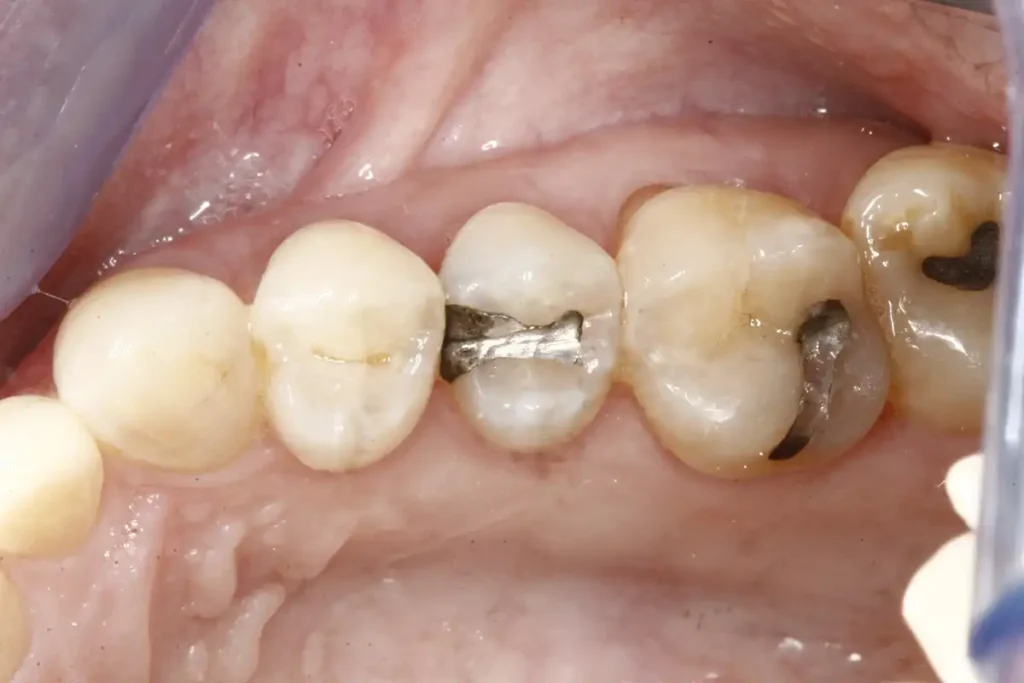 Teeth before a tooth colored dental filling using CEREC technology at Cary Implant and General Dentistry in Cary, NC.