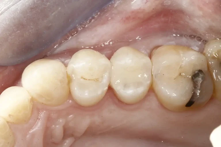 Teeth after a tooth colored dental filling using CEREC technology at Cary Implant and General Dentistry in Cary, NC.